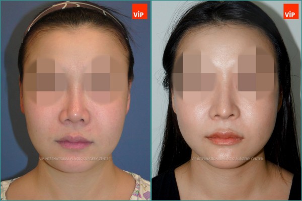 Nose Surgery - Nâng mũi bằng sụn sườn, Nâng vùng giữa mặt