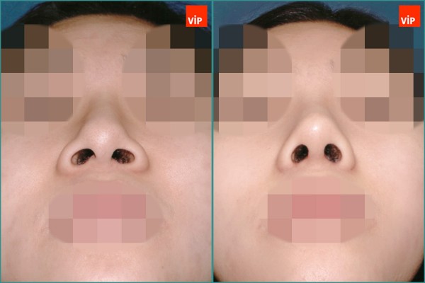 Nose Surgery - Nâng mũi bằng sụn vách ngăn