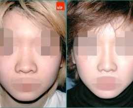 Nâng mũi bằng sụn vách ngăn