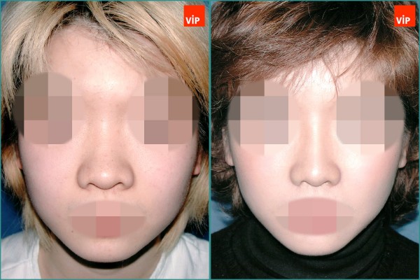 Nose Surgery - Nâng mũi bằng sụn vách ngăn