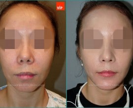 Nâng mũi bằng sụn sườn