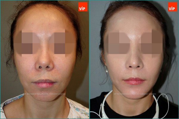 Nose Surgery - Nâng mũi bằng sụn sườn