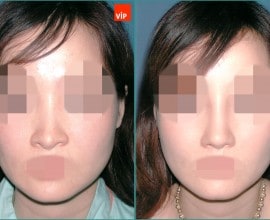Nâng mũi bằng sụn vách ngăn