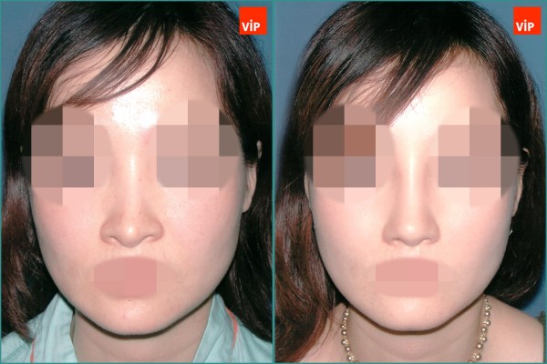 Nose Surgery - Nâng mũi bằng sụn vách ngăn