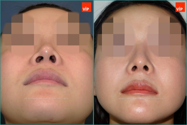 Nose Surgery - Nâng mũi bằng sụn sườn, Nâng vùng giữa mặt