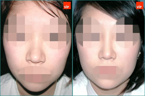 Nose Surgery - Nâng mũi bằng sụn vách ngăn