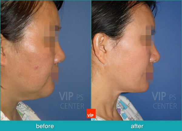 Face Lift - Căng da mặt/cổ High-Smas