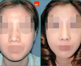 Nâng mũi bằng sụn vách ngăn