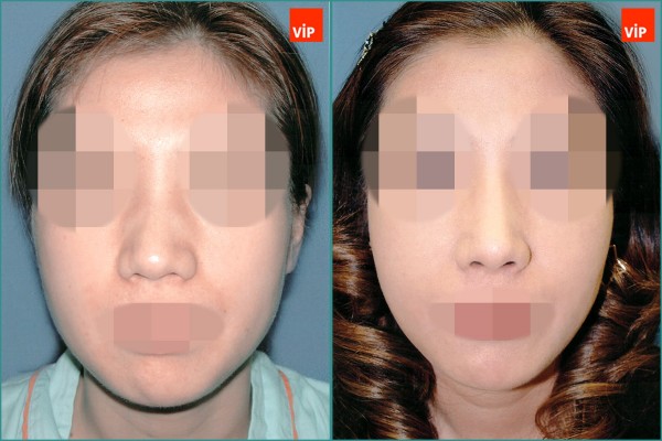 Nose Surgery - Nâng mũi bằng sụn vách ngăn