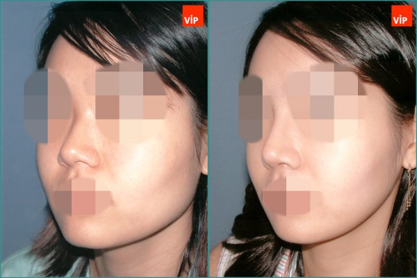 Nose Surgery - Nâng mũi bằng sụn vách ngăn