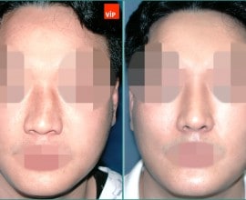 Mũi bị lệch