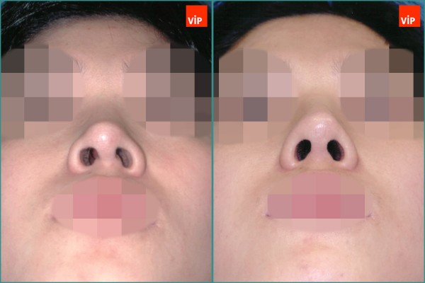 Nose Surgery - Nâng mũi bằng sụn vách ngăn