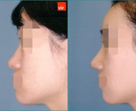 Nâng mũi bằng sụn vách ngăn