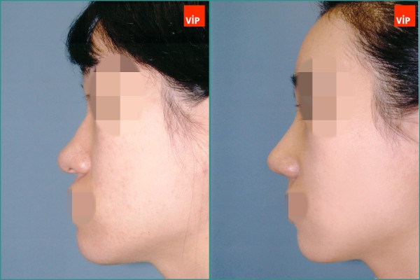 Nose Surgery - Nâng mũi bằng sụn vách ngăn