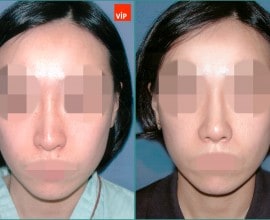Nâng mũi bằng sụn vách ngăn