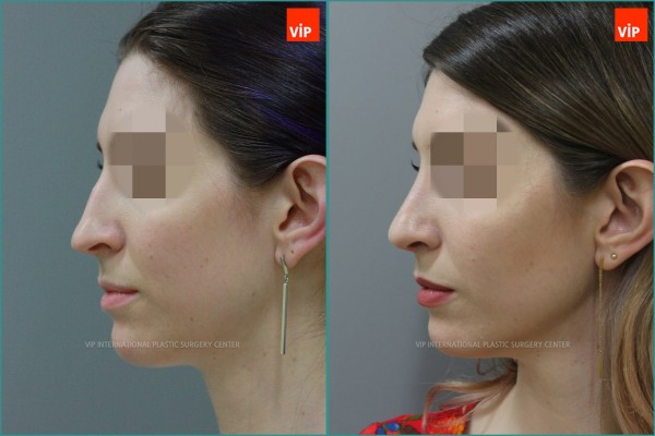 Nose Surgery - Nâng mũi bằng sụn vách ngăn