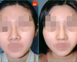Nâng mũi bằng sụn vách ngăn