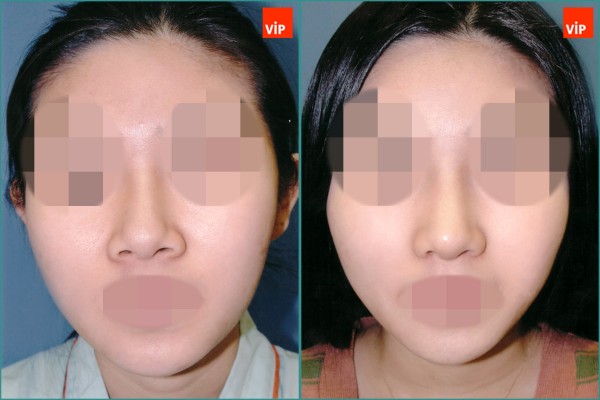 Nose Surgery - Nâng mũi bằng sụn vách ngăn