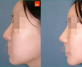 Nâng mũi bằng sụn vách ngăn