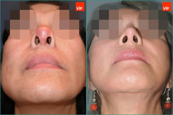 Nose Surgery - Căng da mặt, Tái phẫu thuật mũi, Nâng mũi bằng sụn sườn