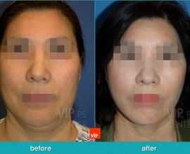 Căng da mặt/cổ High SMAS