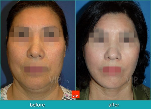 Face Lift - Căng da mặt/cổ High SMAS