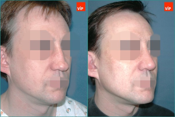 Nose Surgery - Nâng mũi bằng sụn vách ngăn, Nâng vùng giữa mặt
