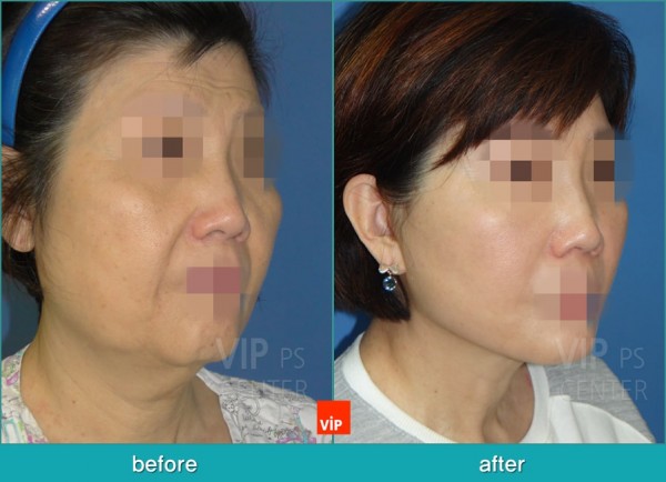 Face Lift - Căng da mặt/cổ High SMAS