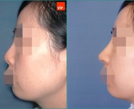 Nâng mũi bằng sụn vách ngăn