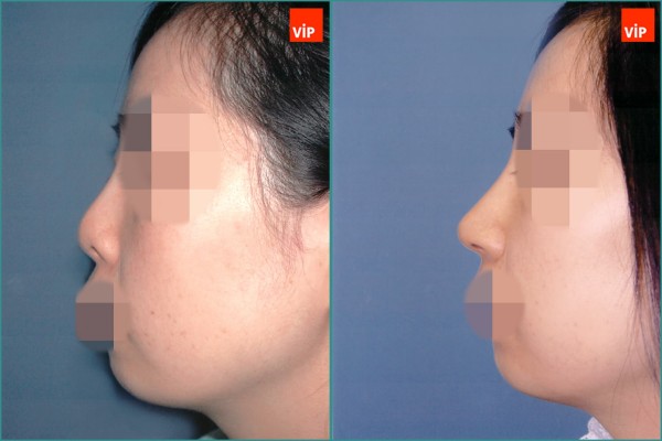 Nose Surgery - Nâng mũi bằng sụn vách ngăn