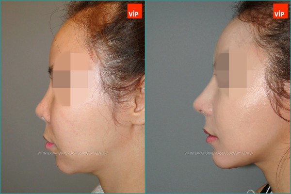 Nose Surgery - Nâng mũi bằng sụn sườn