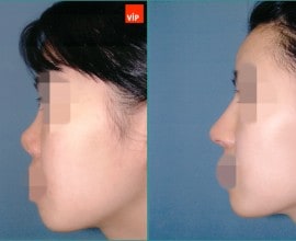 Nâng mũi bằng sụn sườn