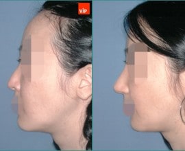 Nâng mũi bằng sụn vách ngăn