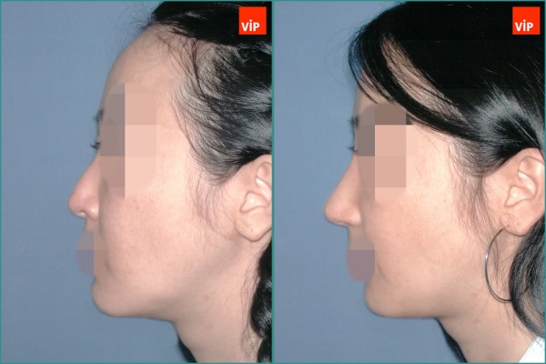 Nose Surgery - Nâng mũi bằng sụn vách ngăn