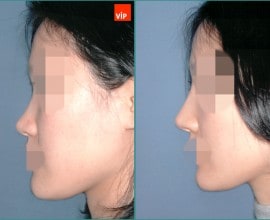 Nâng mũi bằng sụn vách ngăn