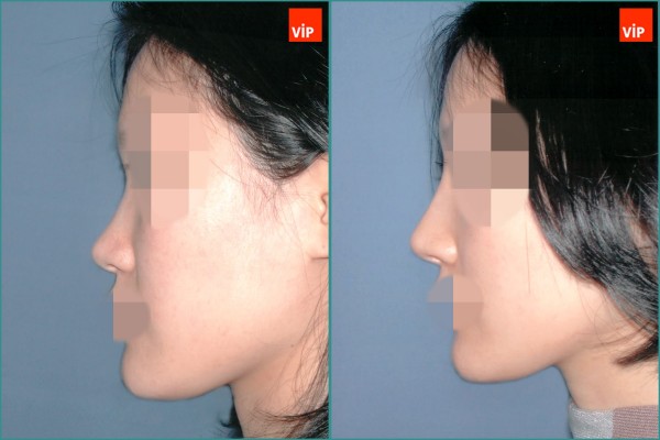 Nose Surgery - Nâng mũi bằng sụn vách ngăn