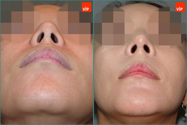 Nose Surgery - Nâng mũi bằng sụn sườn