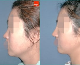 Nâng mũi bằng sụn vách ngăn