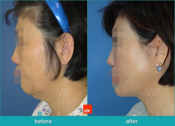 Face Lift - Căng da mặt/cổ High SMAS