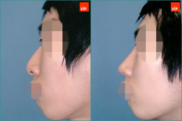 Nose Surgery - Mũi gồ