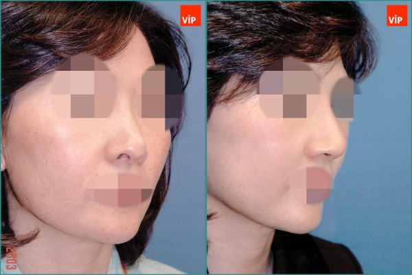 Nose Surgery - Nâng mũi bằng sụn vách ngăn
