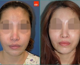 Nâng mũi bằng sụn sườn