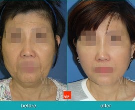 Căng da mặt/cổ High SMAS