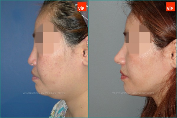 Nose Surgery - Nâng mũi bằng sụn sườn