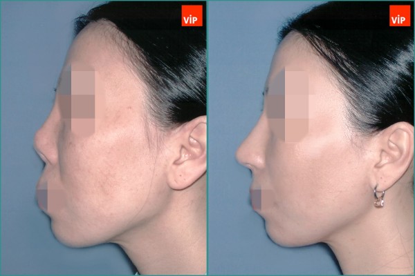 Nose Surgery - Nâng mũi bằng sụn sườn