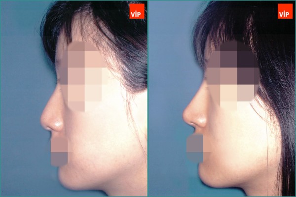 Nose Surgery - Nâng mũi bằng sụn vách ngăn