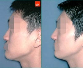Nâng mũi bằng sụn sườn