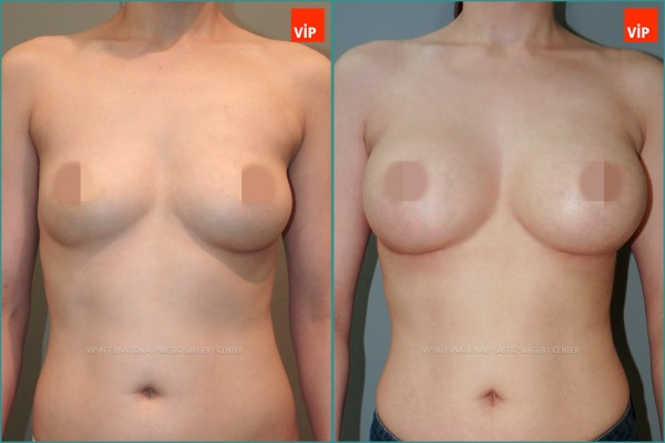 Breast Surgery - Nâng ngực