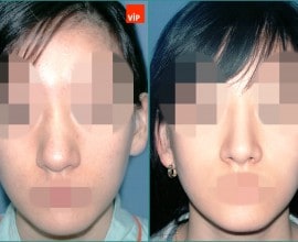 Nâng mũi bằng sụn vách ngăn