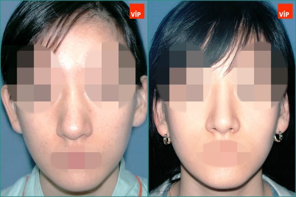 Nose Surgery - Nâng mũi bằng sụn vách ngăn
